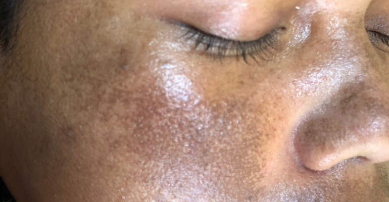 Melasma: Causes, Triggers, and Treatment