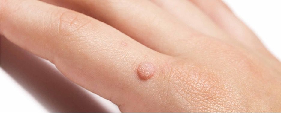 Common Causes of Skin Warts and Prevention Strategies
