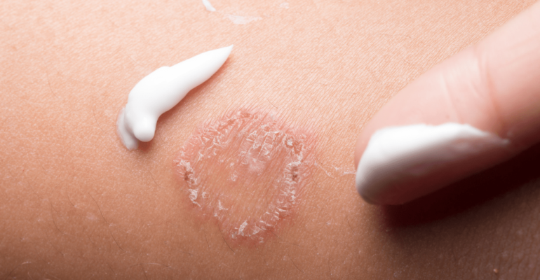 Ringworm or Tinea: Dermatologist Guide