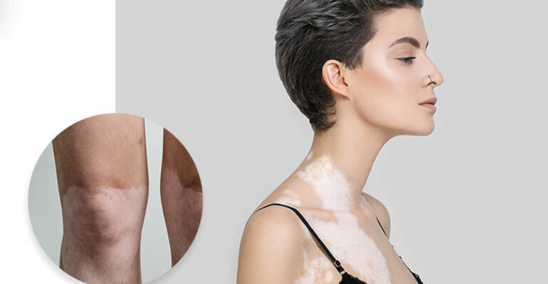 Is That White Patch- Leukoderma or Vitiligo : Skin Diseases: Vitiligo And Leukoderma | treatment | Homeopathic | Best Homeopathic Doctor in Pakistan | Dr Qaisar Ahmed MD, DHMS