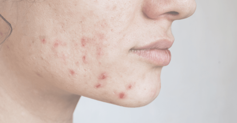 How to Get Rid of Hormonal Acne : Lifestyle and Skincare Tips