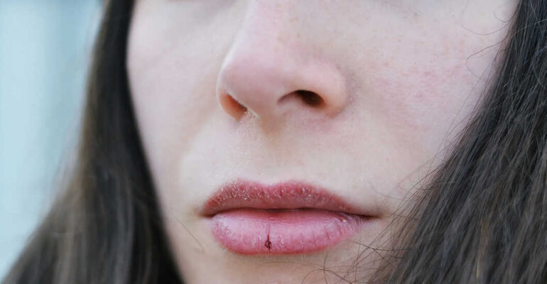 5-Step Regimen for Chapped Lips