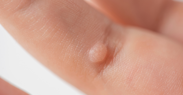 Warts: Causes, Symptoms, Prevention, and Treatment