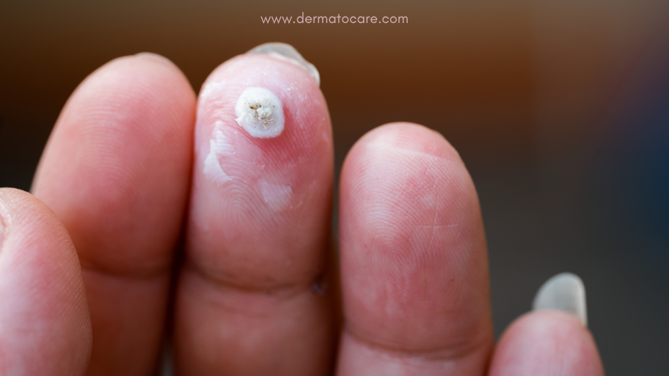 Tea tree oil for Warts I Dermatologist Guide