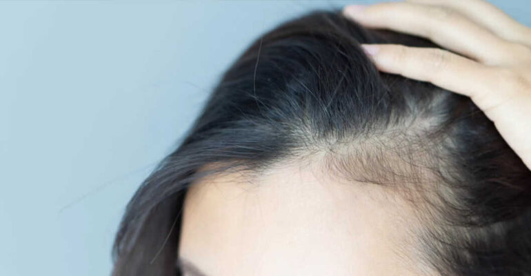 What is Seborrheic Dermatitis? Causes, Diagnosis & Latest Treatments