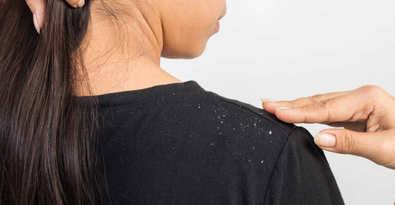 Dandruff: Causes, Types, & Treatment