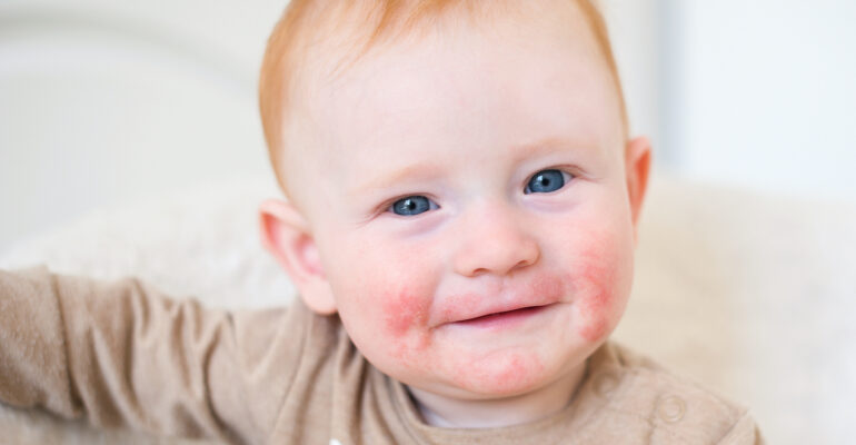 Atopic dermatitis treatment I Dermatologist guide