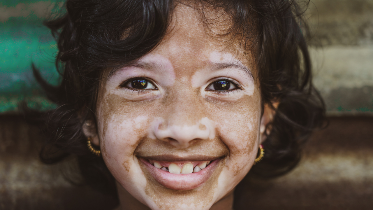 Pityriasis alba vs Vitiligo I Dermatologist Guide
